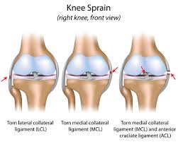 A torn ligament severely limits knee movement. Ems Evaluation And Management Of Limb Threatening Knee Injuries Jems
