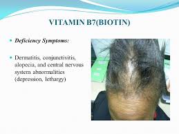 Namely, vitamin d stimulates the growth of follicles. Micronutrient Deficiency Disorders Nutritional Deficincy Disorders Objectives Discuss Common Micronutrient Deficiencies Disorders Ppt Download