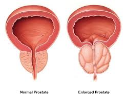 Prostate cancer is a condition that causes abnormal cells to develop within the prostate gland. Astepaway New Search Experience Enlarged Prostate Prostate Health Prostate