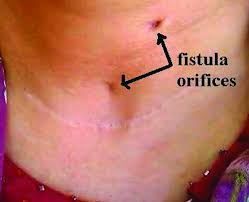 The main reason is that unless you get rid of the disease, the granulomas often grow back. A Complication Of Thyroidectomy Do Not Forget Suture Reaction Abstract Europe Pmc