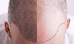 Hair loss questions are likely some of the biggest health and beauty concerns that most people face today. Questions To Ask Your Dermatologist About Hair Transplant Surgery