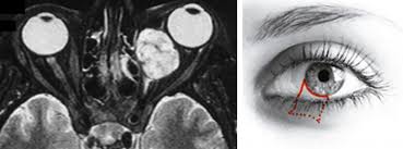 Orbitachirurgie Und Tumoren Mit Sehnervenkompression Neuroonkologisches Zentrum Clemenshospital Munster