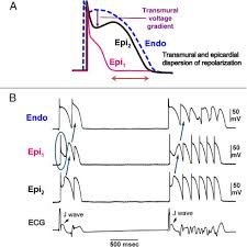 The easy grades and wide path make this trail a nice, pleasant stroll to enjoy a quiet time in the woods and the nearby brook. Clinical And Mechanistic Issues In Early Repolarization Of Normal Variants And Lethal Arrhythmia Syndromes Sciencedirect