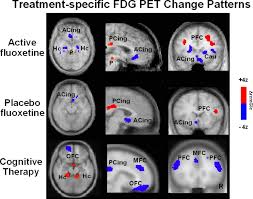 Image result for Placebo Effect