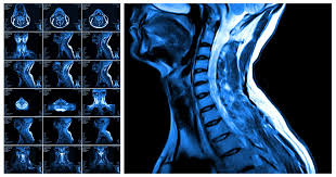 So when we go back to the image, you will notice that it can be difficult to find the nerve. Do I Need An Mri Scan