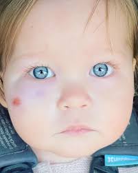 Our baby girl turns 1 tomorrow. Yesterday, she got her first shiner!  @forthewynnwragge @sarahwraggewellness #WW21 One tough cookie. (Christian  had nothing to do with this!)