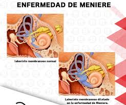 Chamada também de hidropsia endolinfática, aumenta a pressão do liquido no ouvido. Recordemos La Enfermedad De Meniere Terapia De Lenguaje Y Aprendizaje Facebook