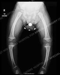 Blount S Disease Bowleg Treatment Hss Pediatric Orthopedics