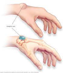 How do you get a ganglion cyst on your wrist? Ganglion Cyst Symptoms And Causes Mayo Clinic