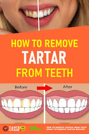 Check spelling or type a new query. How To Remove Tartar Buildup From Teeth Tasteandcraze