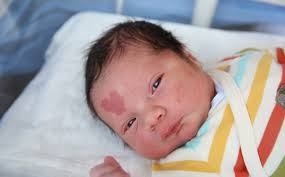 Penduduk yang berisiko tinggi untuk jangkitan ini adalah bayi baru lahir. Risau Tanda Lahir Pada Bayi Boleh Hilang Atau Tak Apabila Besar Ini Jawapannya Pa Ma