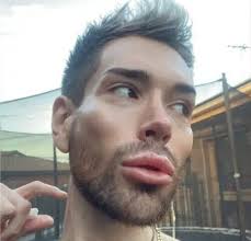 Un joven se gasta 70.000 euros en cirugías para convertirse en un 'Ken  Humano'