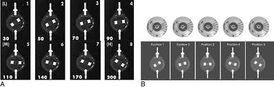Fig 3 Programmable Csf Shunt Valves Radiographic Identification And Interpretation American Journal Of Neuroradiology