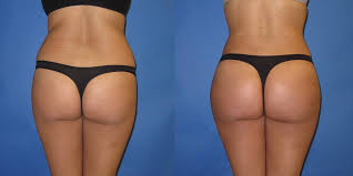 Maybe you would like to learn more about one of these? Brazilian Butt Lift In Portland Oregon