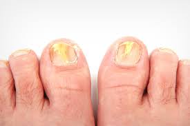 home remes to treat toenail fungus