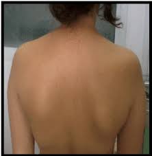 Soft lump on shoulder blade. Solitary Osteochondroma Of The Scapula An Uncommon Localization