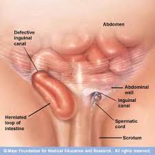 Cara membuat senapan angin pcp sendiri merakit senapan pcp sendiri halo teman teman sobat bediler semua, postingan kali ini akan memba. Inguinal Hernia Angin Pasang