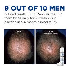 I have been losing hair in the last two years and now my hair is very thin. Amazon Com Men S Rogaine 5 Minoxidil Foam For Hair Loss And Hair Regrowth Topical Treatment For Thinning Hair 1 Month Supply Beauty