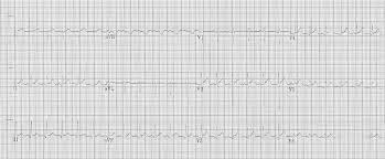 The ecg is used to diagnose acute pericarditis. Myocarditis Ecg Changes Litfl Ecg Library Diagnosis