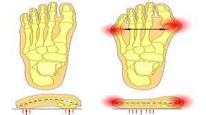 Image result for Hallux Varus