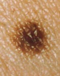 Melanoma is the rarest form of skin cancer, and the only one linked to new or changing moles. Digital Dermoscopy Mole Looks Very Different From Last Image Scary Symptoms