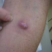 Go to my profile and you can find all about get rid of acne material there. Cyst Removal Surgery 250 Learn More About Cysts