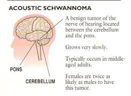 Benign Brain Tumors Non Cancerous Tumor Brain Surgery Com Brain Tumor Tumor Brain Tumor Symptoms
