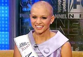 Kontestan 'Putri Cantik' yang Menderita Kebotakan