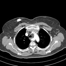 Questa malattia rimane sottovalutata in quanto in più del 50% dei casi l'episodio di embolia polmonare acuta passa inosservato e i pazienti non manifestano altro che un certo grado di insufficienza cardiaca destra. Embolia Polmonare Quadro Angiotac Daddydoctorgym Com