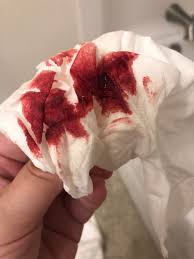 The loss of the mucus plug usually signals that labor is imminent, though it can be up to two weeks before. Help Bleeding 6 Weeks Tmi Picture Trying To Conceive Forums What To Expect