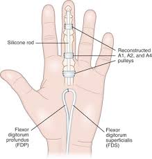 Fibrin degradation product or fdp is a product of fibrinolysis that remains after the clot has been dissolved. Two Stage Reconstruction With The Modified Paneva Holevich Technique Plastic Surgery Key