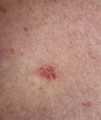 Skin cancer is one of the most common types of cancer. Skin Cancer Rates Higher In Gay Bisexual Men