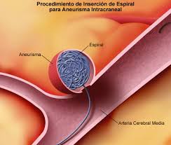 Un aneurisma cerebral es una enfermedad cerebrovascular que puede provocar hemorragia en el cerebro. Cerebral Aneurysm