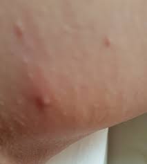 You can get rid of deep ingrowing hairs by practicing proper shaving techniques. How To Remove A Deep Ingrown Pubic Hair Ingrown Hair
