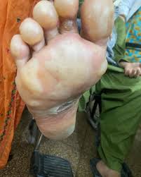 Image result for pompholyx soles of feet