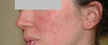 Etiology, pathogenesis, and subtype classification. Acne Or Rosacea Ducray