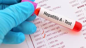 Start studying hepatitis b antibodies. Hepatitis A Kenali Gejala Penyebab Dan Cara Penyembuhannya