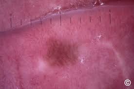 Image result for Macule