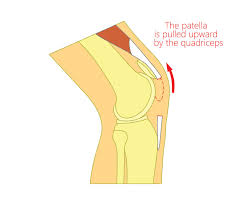 Malalignment of the foot, ankle, and leg can play a key role in tendonitis. Patella Tendon Rupture Upswing Health