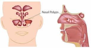 They result from chronic inflammation and are associated with asthma, recurring infection, allergies, drug sensitivity or certain immune disorders. Nasal Polyps Otolaryngology Specialists Of North Texas
