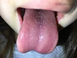 Image result for Puchýře na jazyku