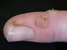 | #ketuat kaki hilang dengan semburan #crystalsoul haa buat yang ada #ketuat tu, sangat la sesuai guna semburan #garambukit ni. 5 Penyebab Terjadinya Benjolan Di Jari Tangan Dan Kaki