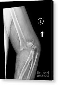 Image result for Elbow XRay