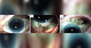 Image result for melanosis sclera