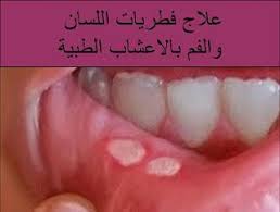 البيت العربي علاج فطريات اللسان والفم بالاعشاب الطبية Blog Posts Blog Post