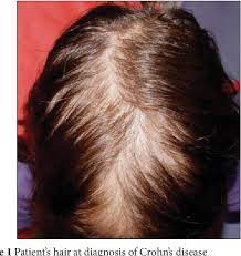 Hi @sandyjr that must be so frustrating to have your daughter experience hair loss along with the crohn's symptoms. Figure 1 From Telogen Effluvium As The First Symptom Of Crohn S Disease In A Child Semantic Scholar