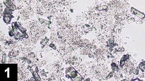 Struvite Crystalluria Three Cases Clinician S Brief