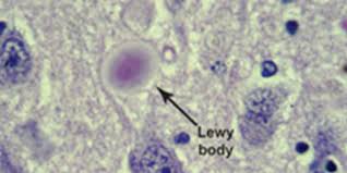 Dementia with lewy bodies or lewy body dementia is dementia caused by the presence of lewy bodies in the brain. Lewy Body Dementia Lbd Symptoms Causes Alz Org