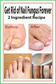 Get Rid Of Nail Fungus Forever 2 Ingredient Recipe Forever Fungus Ingredient Nail Nailfungu In 2020 Toe Fungus Remedies Toenail Fungus Home Remedies Toe Fungus