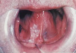He may do endoscopy by passing lighted instrument. Nursing Patients With Oral Cancer